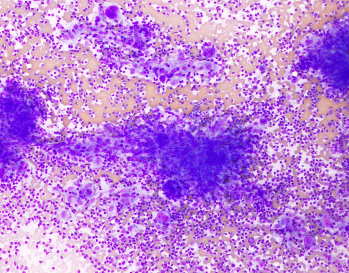 Cervical lymph node FNA: Hodgkin lymphoma

This case had both classic binucleated Reed-Sternberg cells as well as mononuclear and multinucleated RS cell variants

#CytoPath #PathTwitter