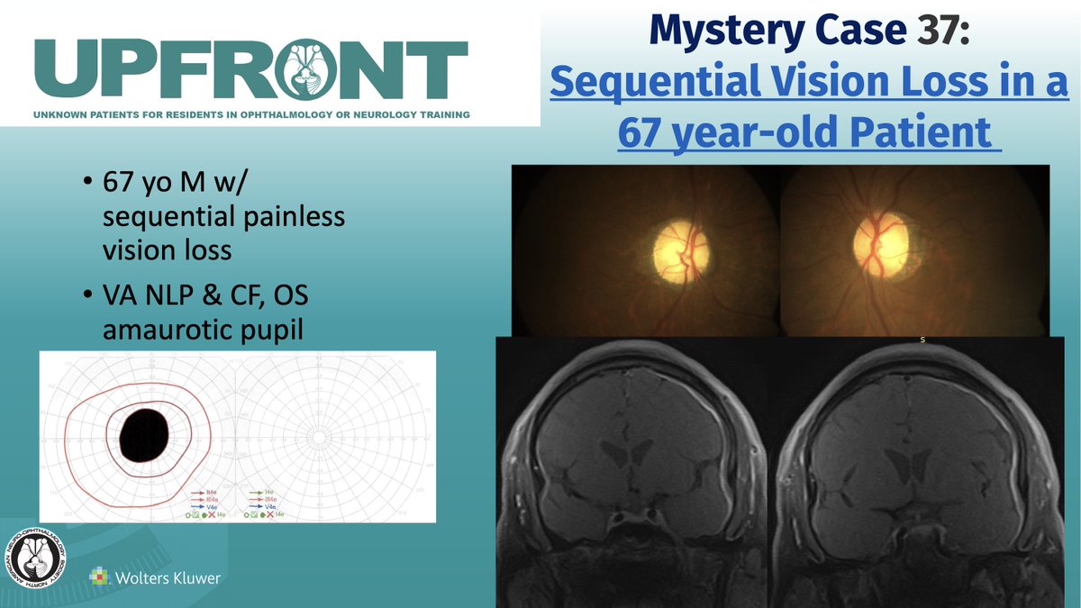 UPFRONT Mystery Case #37: Sequential Vision Loss in a 67 year-oldPatient : Journal of Neuro-Ophthalmology
Article: bit.ly/JNO_UPFRONT_37 or on bit.ly/JNO_Home
 #brain #eye #vision #research #Neurology #NeuroOphth #Ophthalmology #Medicine