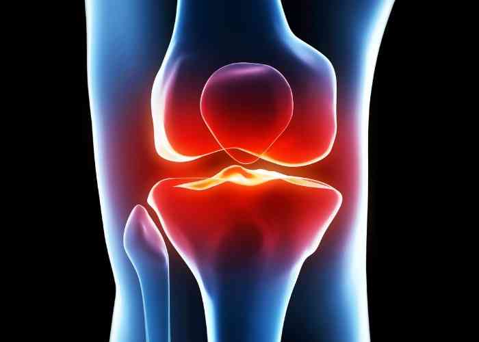 🦵 Tibial Tubercle #Osteotomy Success varies based on your treatment plan:
🔹 With Medial Patellofemoral Ligament Reconstruction: Success rate &gt;80%
🔹 With Cartilage Resurfacing or Lateral Arthritis: Success rate 70-80% over 5 years.
medilink.us/2tcx  #orthotwitter