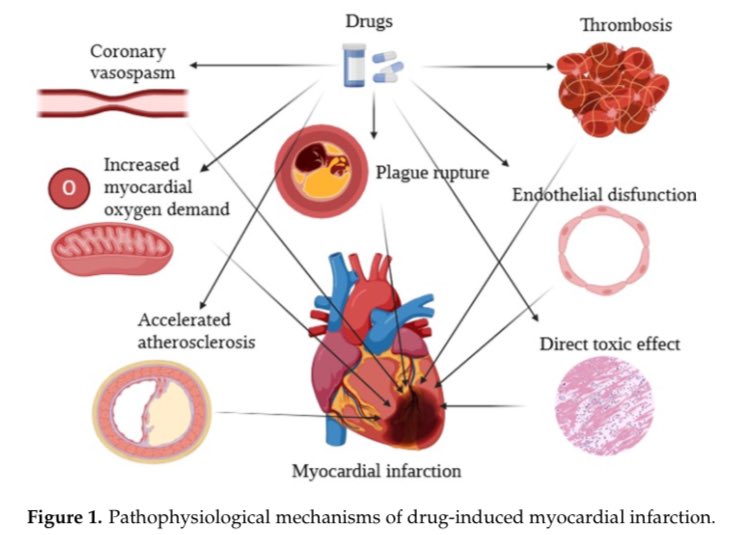📌 La fisiopatología del infarto de miocardio inducido por drogas varía según el tipo de sustancia involucrada, pero generalmente implica un desequilibrio entre la oferta y la demanda de oxígeno en el miocardio, así como efectos pro-trombóticos y vasoconstrictores.

#Cardiology