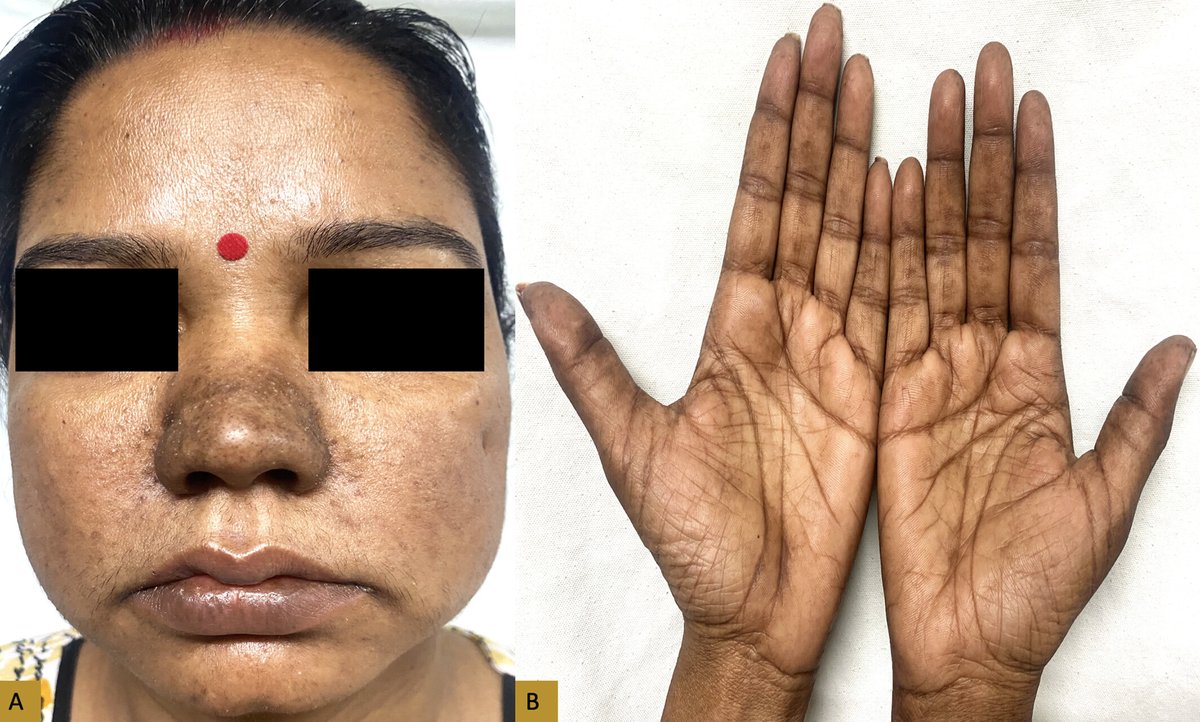 🚨Our latest publication <a href="/ACR_Journals/">ACR_Journals</a> <a href="/ACRheum/">American College of Rheumatology</a> 
<a href="/DrNishant_GMC/">Dr Nishant Kamble MD DM</a> <a href="/sundaram_tg/">Sundaram T G</a> 

#Clinicalpearls
🧐Joint pain with CHIK sign

A quintessential diagnostic clue, yet frequently overlooked #tropicalrheumatism 🌏🦟🦠

📖Read more: doi.org/10.1002/acr2.7…

 #Rheumatology #MedTwitter