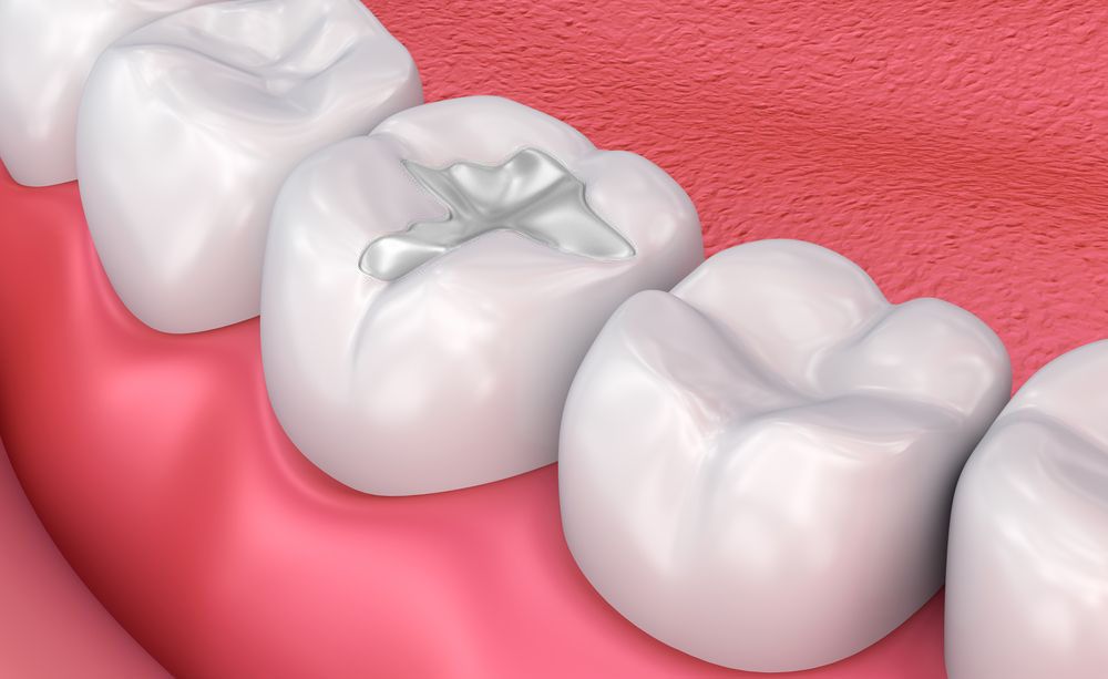 Study Shows Antacids May Damage Dental Restorations:

A study published in BMC Oral Health  observed that antacids increase surface roughness and decrease microhardness of these materials, potentially affecting their longevity and aesthetics.

More Info: ow.ly/hVrv50UWMI7
