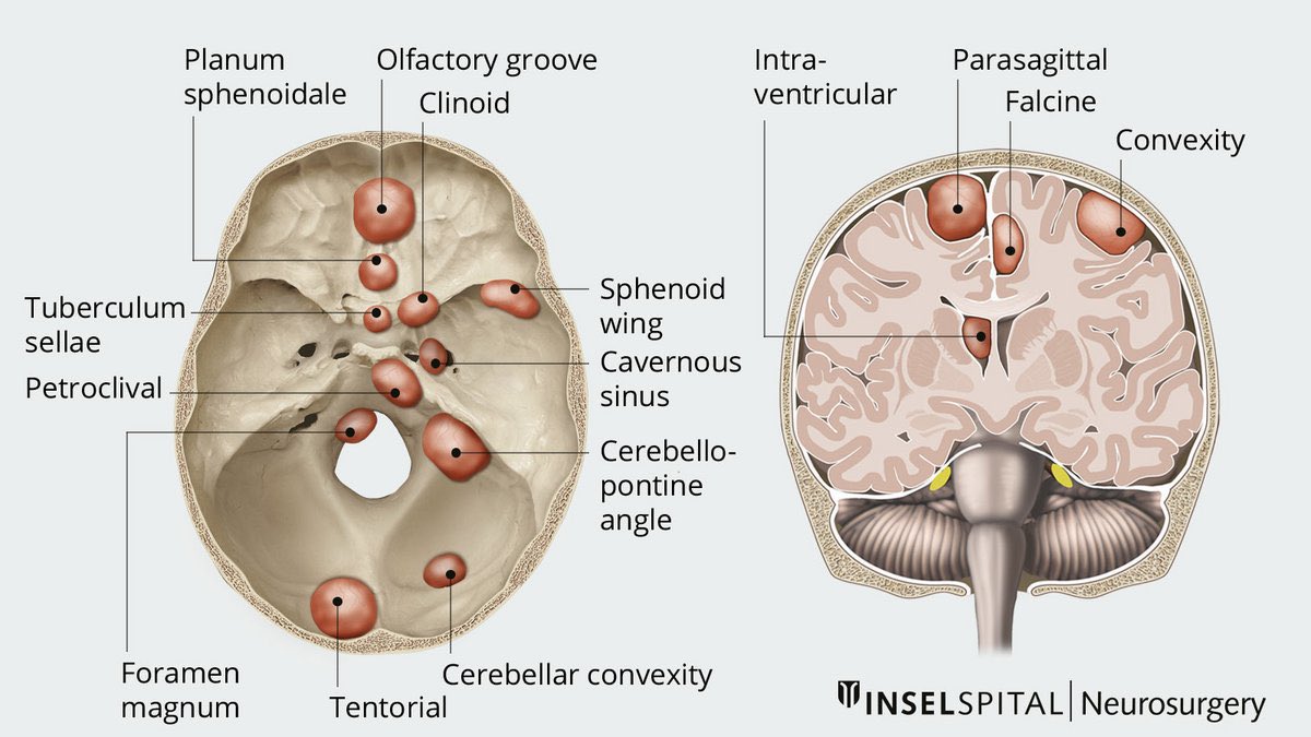 NeuroWalid's tweet photo. Meningiomas #Neuroncology #Neurotip

Tweeted by @seraj25 https://t.co/ocMWG19X1k