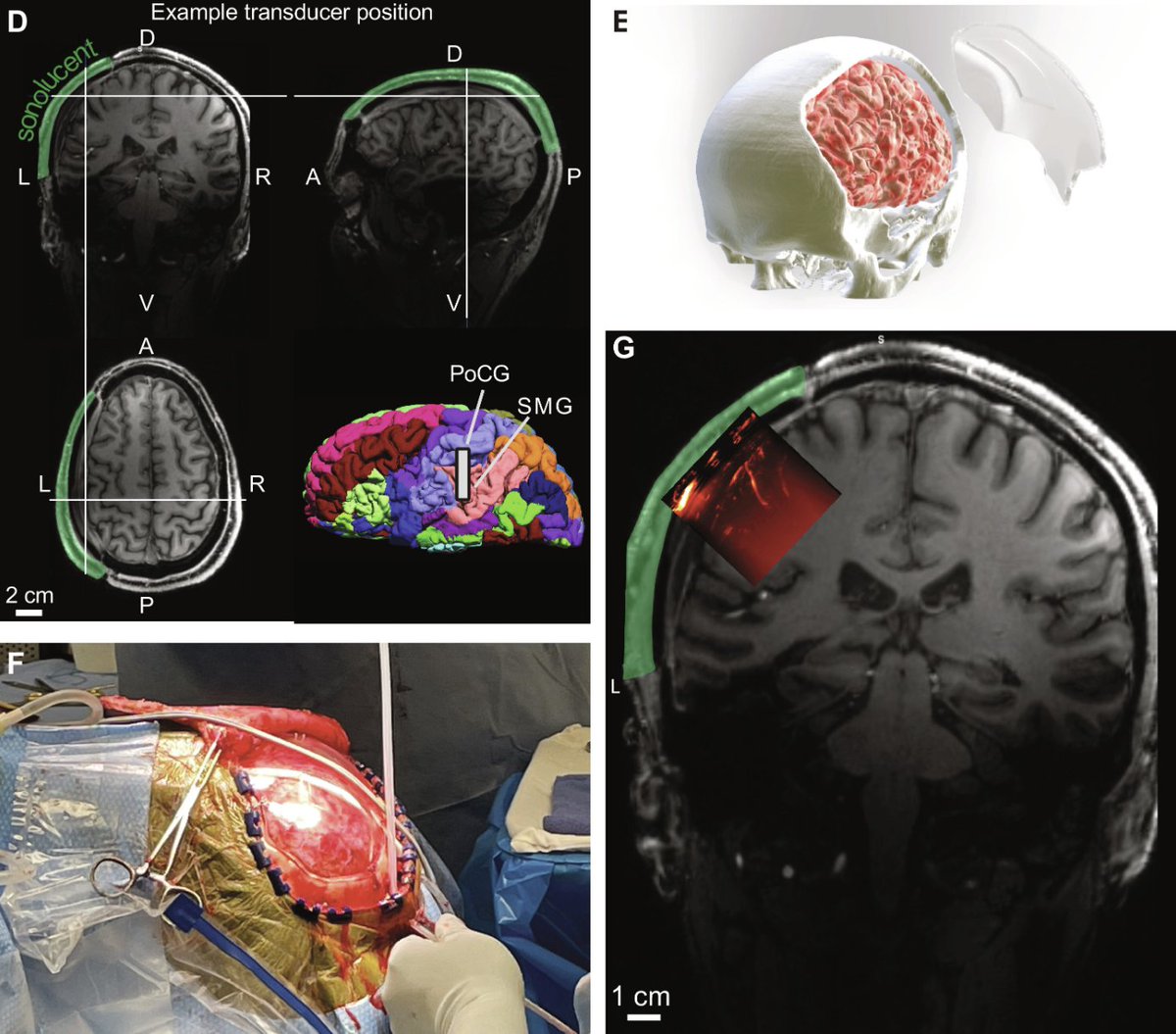 Danny Huang, MD (@yuhaohuangmd) on Twitter photo Ultrasonic brain interface might be the next frontier. <a href="/ScienceTM/">Science Translational Medicine</a> study showed it was possible to measure widespread brain activity using ultrasound through an acoustically transparent skull window, implanted during a reconstructive skull surgery after trauma.
Example of Ultrasonic brain interface might be the next frontier. <a href="/ScienceTM/">Science Translational Medicine</a> study showed it was possible to measure widespread brain activity using ultrasound through an acoustically transparent skull window, implanted during a reconstructive skull surgery after trauma.
Example of