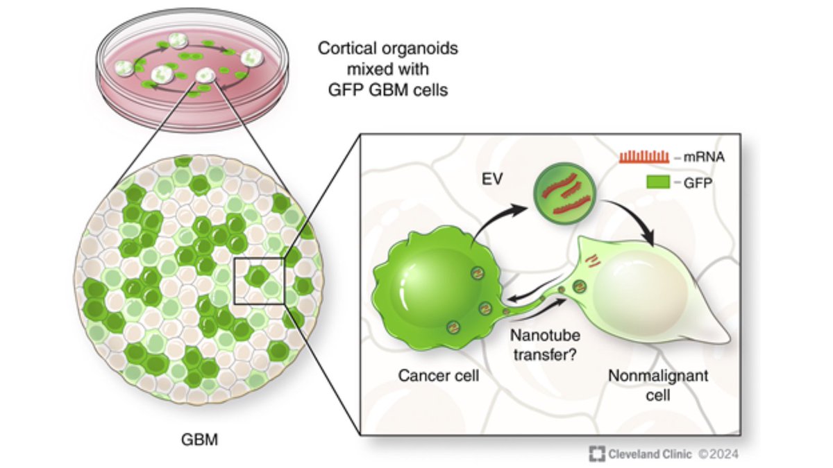 CD_AACR's tweet photo. In the Spotlight: A Material Transfer Agreement between #Glioblastoma and Normal Brain Cells https://t.co/rLfuMRJ2hD
By Sajina Shakya, Christopher Hubert, and @JustinLathia 
@CCLRI @caseccc @ClevelandClinic https://t.co/bn3rbz55x7