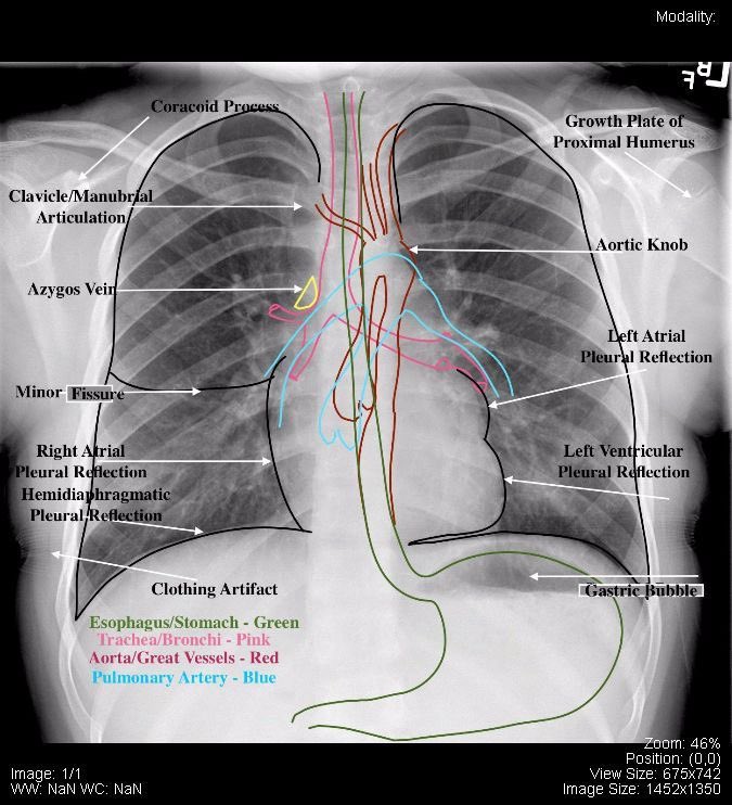 Chest Xray anatomy