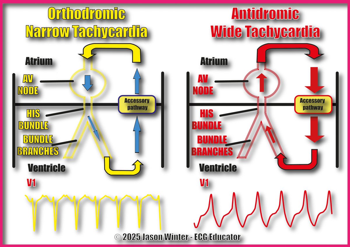 The ECG Educator 🩺 🫀 tweet media