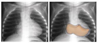 LaLoTomas3's tweet image. La imagen radiográfica en zapato zueco (sueco) 🥾🇳🇱 o en botita 👢es característica de la Tetralogía de Fallot o de la Atresia Pulmonar #T4F #AP #CardioPedMx