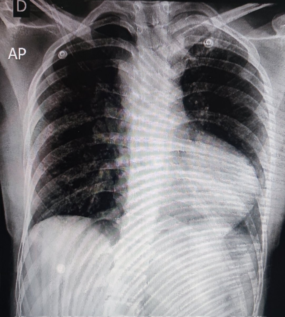 LaLoTomas3's tweet image. La imagen radiográfica en zapato zueco (sueco) 🥾🇳🇱 o en botita 👢es característica de la Tetralogía de Fallot o de la Atresia Pulmonar #T4F #AP #CardioPedMx