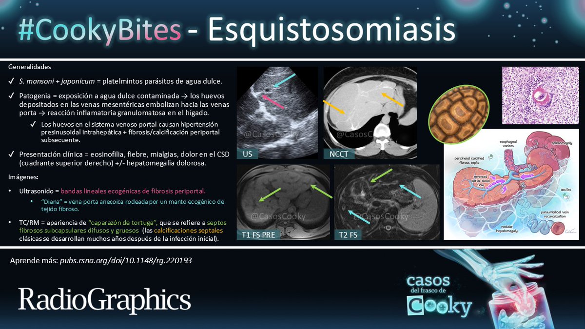 Casos de Cooky (@casoscooky) on Twitter photo Respuesta: Esquistosomiasis
Aprende más: pubs.rsna.org/doi/10.1148/rg…
Traducido por: <a href="/MariaLuciaBrunV/">MaríaLucía Brun-Vergara</a>
#CasosCooky #CookyBites #156 #RGphx <a href="/cookyscan1/">Cooky Menias</a> <a href="/RadioGraphics/">RadioGraphics</a> Respuesta: Esquistosomiasis
Aprende más: pubs.rsna.org/doi/10.1148/rg…
Traducido por: <a href="/MariaLuciaBrunV/">MaríaLucía Brun-Vergara</a>
#CasosCooky #CookyBites #156 #RGphx <a href="/cookyscan1/">Cooky Menias</a> <a href="/RadioGraphics/">RadioGraphics</a>