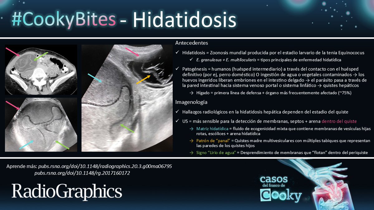 Casos de Cooky (@casoscooky) on Twitter photo Respuesta: Hidatidosis
Aprende más: pubs.rsna.org/doi/10.1148/ra…
pubs.rsna.org/doi/10.1148/rg…
#CasosCooky #157 #CookyBites #RGphx <a href="/cookyscan1/">Cooky Menias</a> <a href="/RadioGraphics/">RadioGraphics</a>
Traducción: <a href="/MaxiKlugMD/">Maximiliano Klug</a> Respuesta: Hidatidosis
Aprende más: pubs.rsna.org/doi/10.1148/ra…
pubs.rsna.org/doi/10.1148/rg…
#CasosCooky #157 #CookyBites #RGphx <a href="/cookyscan1/">Cooky Menias</a> <a href="/RadioGraphics/">RadioGraphics</a>
Traducción: <a href="/MaxiKlugMD/">Maximiliano Klug</a>