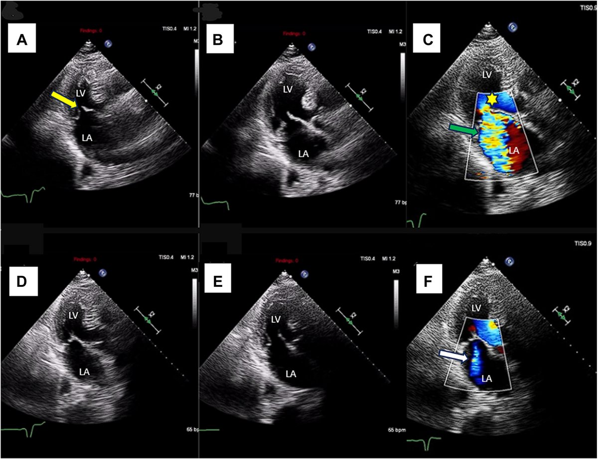 American Society of Echocardiography (@ase360) on Twitter photo We describe a case of an emotionally stressed patient who presented with severe mitral regurgitation with a structurally normal mitral valve and LV function that rapidly subsided to mild MR once the patient became calmer.
Read our <a href="/CASEfromASE/">CV Case Journal</a> report: bit.ly/4b3JPL6 We describe a case of an emotionally stressed patient who presented with severe mitral regurgitation with a structurally normal mitral valve and LV function that rapidly subsided to mild MR once the patient became calmer.
Read our <a href="/CASEfromASE/">CV Case Journal</a> report: bit.ly/4b3JPL6