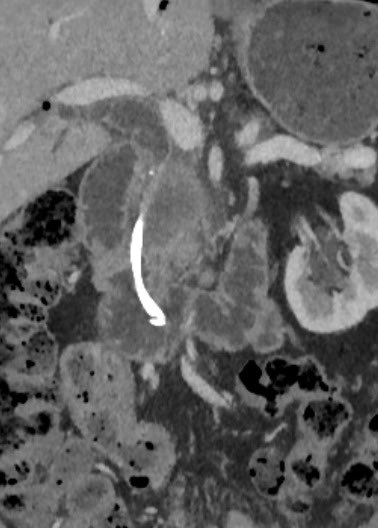 52 y/o M with advanced pancreatic carcinoma
Palliative biliary stent placed, but persistent pain &amp; jaundice prompted CT.
➡️ Stent migrated to the duodenum.
🔍 friendly reminder: Always report stent permeability &amp; localization. #Radiology #MedTwitter #foammed #pancreaticcancer
