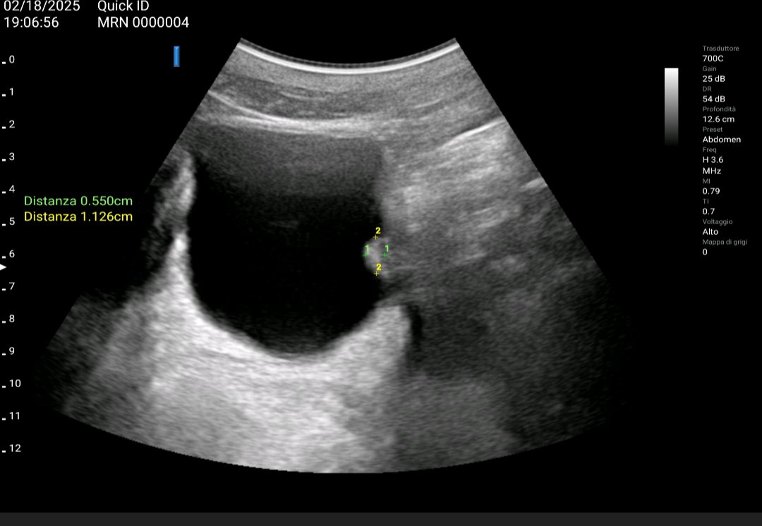 #pocus
Small bladder left lateral lesion