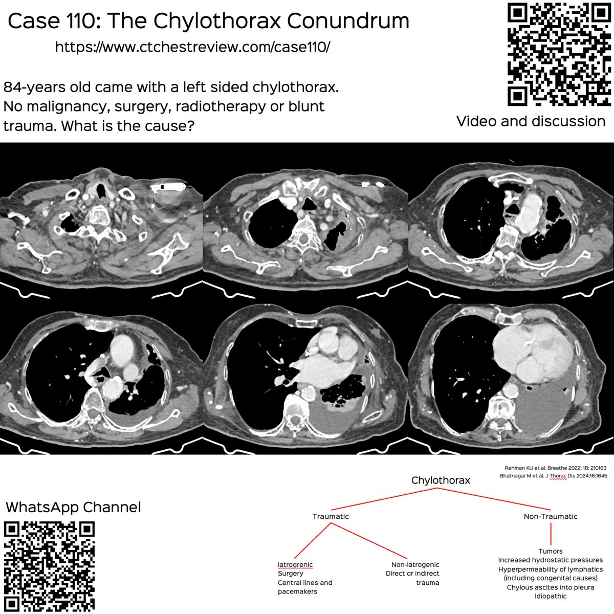 bhavinj's tweet photo. Case 110: The Chylothorax Conundrum
84-years old with left chylothorax
https://t.co/kt9x7dH9hg
Video discussion of case and a basic approach to chylothorax.
#ctchest #radres #foamrad #pleura #chylothorax https://t.co/fcfNgcwrs9