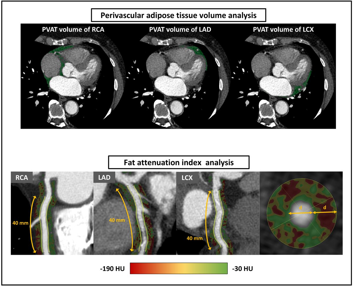 Twinkle_IMR's tweet photo. Dr. Yuichi Saito’s latest study explores the relationship between coronary vasospasm &amp; perivascular adipose tissue (PVAT) using coronary CTA. 

Check it out! https://t.co/vsiljbcs5C

#Cardiology #CoronaryVasospasm #CTA #CardiovascularResearch #PVAT #VascularHealth #HeartDisease https://t.co/JAvyVsJ3dA