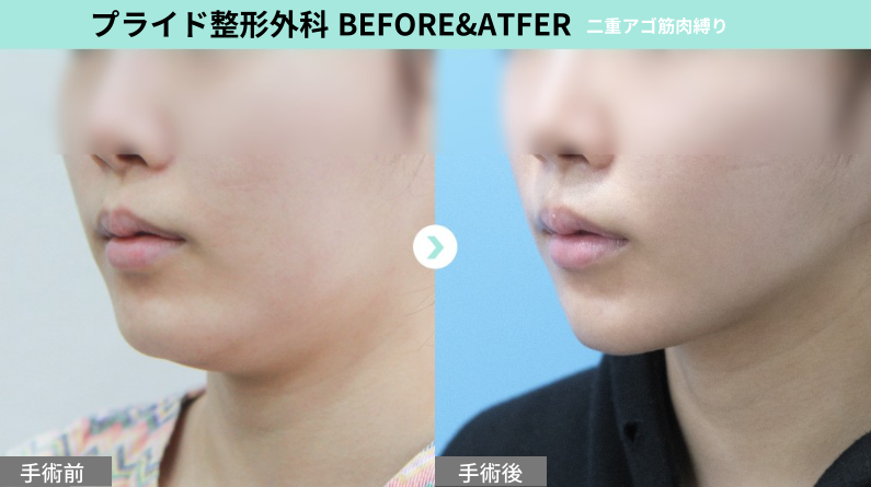 prideseikei's tweet photo. ﾟ･:.｡..｡.:･’ * * ‘･:.｡. .｡.:･ﾟ
PRIDE Before & After

二十顎が改善されるだけで
横から見た��のフェイスラインが😳👏🏻

ダイエットではなかなか落ちない二十顎、
PRIDEで簡単に除去しましょう💙

公式LINE🔎https://t.co/FJesX3fxwM

#ペリカン手術 #二十顎 #筋肉縛り #顎下筋肉縛り #顎下脂肪吸引 #整形 #韓国整形 #渡韓整形 #症例 #整形垢 #整形垢さんと繋がりたい #プライド美容外科