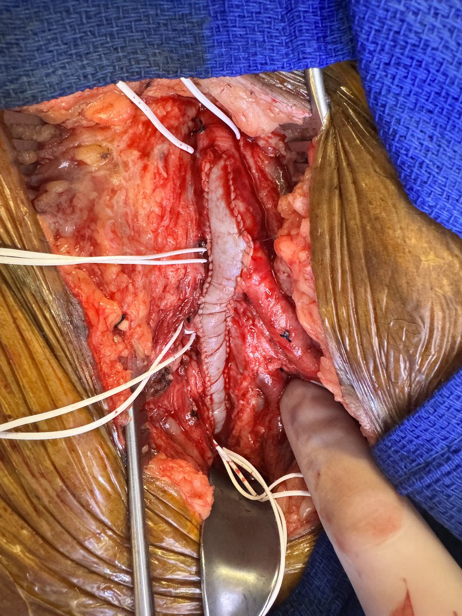 JHH Vascular Surgery (@jhhvascular) on Twitter photo Nothing we love more than a good femoral reconstruction! #savetheprofunda #limbsalvage #CLTI #vasculareducation <a href="/CaitlinWHicks/">Caitlin Hicks MD, MS</a> <a href="/JamesHBlackMD/">James H Black, MD</a> <a href="/YWLum/">Ying-Wei Lum</a> <a href="/WenKawaji/">Wen Kawaji, MD, MS</a> Nothing we love more than a good femoral reconstruction! #savetheprofunda #limbsalvage #CLTI #vasculareducation <a href="/CaitlinWHicks/">Caitlin Hicks MD, MS</a> <a href="/JamesHBlackMD/">James H Black, MD</a> <a href="/YWLum/">Ying-Wei Lum</a> <a href="/WenKawaji/">Wen Kawaji, MD, MS</a>