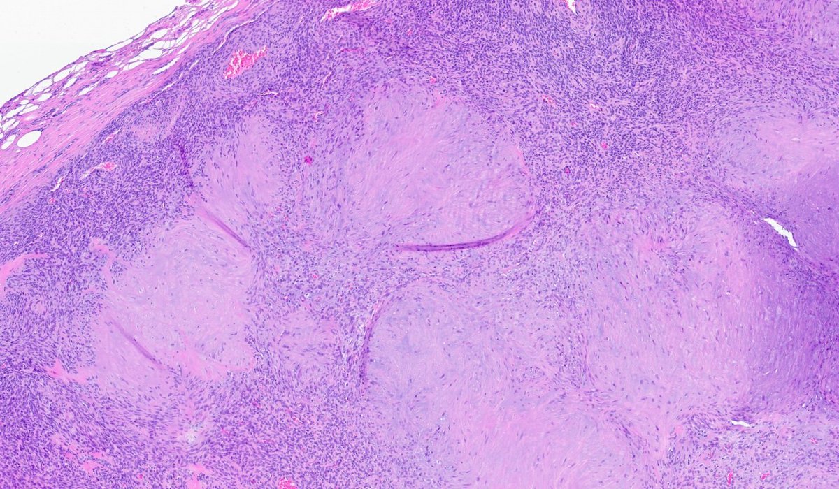meeting an "old friend" - classic myoepithelioma!