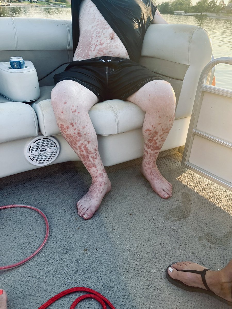 LakerLife10's tweet image. My sister passed out twice after the 💉 and now has blood pressure problems. My brother-in-law who was a jet blue pilot died 6 months after receiving the 💉 and my other brother-in-law broke in a rash all over his body. My father could see fine one day and the next he was on his…