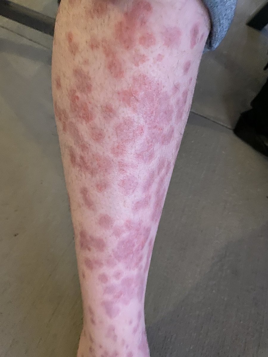 LakerLife10's tweet image. My sister passed out twice after the 💉 and now has blood pressure problems. My brother-in-law who was a jet blue pilot died 6 months after receiving the 💉 and my other brother-in-law broke in a rash all over his body. My father could see fine one day and the next he was on his…