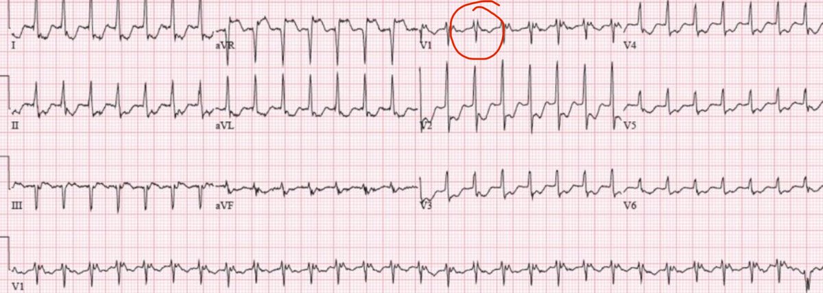Marco Bergonti (@mbergonti) on Twitter photo Are you 100% certain about the diagnosis of this SVT? 😎
If not, you need to follow the <a href="/escardio/">European Society of Cardiology</a> #EHRA Webinar - Mastering SVT diagnosis: tips and tricks for the 12-lead ECG
📅 5 March 2025,
🕰️6-7 PM CET
👉 esc365.escardio.org/event/1924
With <a href="/Dominik_Linz/">Dominik Linz</a> <a href="/DrCherylTeresEP/">Cheryl Teres</a> Are you 100% certain about the diagnosis of this SVT? 😎
If not, you need to follow the <a href="/escardio/">European Society of Cardiology</a> #EHRA Webinar - Mastering SVT diagnosis: tips and tricks for the 12-lead ECG
📅 5 March 2025,
🕰️6-7 PM CET
👉 esc365.escardio.org/event/1924
With <a href="/Dominik_Linz/">Dominik Linz</a> <a href="/DrCherylTeresEP/">Cheryl Teres</a>