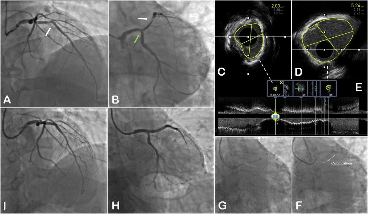 Vessel_Plus's tweet photo. 🚨New study on #CoronaryAtherectomy!
#Sheathless radial approach in contemporary #coronaryrotationalatherectomy: data from two high-volume centers
A promising #Cardiology advancement!🔬💉
#HeartHealth #InterventionalCardiology #Vascular #MedicalResearch
https://t.co/6It7zH3eC8 https://t.co/Je3wamimuq