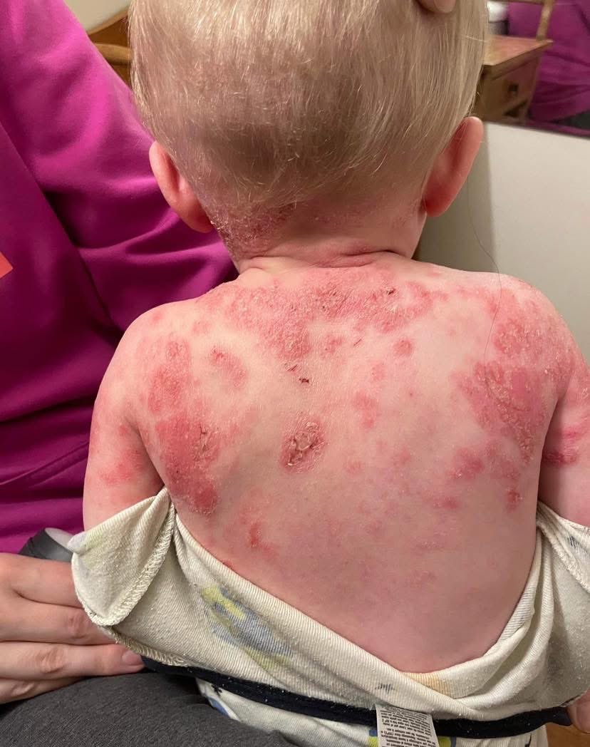 toobaffled's tweet photo. “I trusted my child’s doctors and listened to their suggestions. We followed all the rules. Did everything “right.” Took all advice. We got every vaccination. We ended up struggling with our first sons skin badly. Tried EVERY over the counter eczema treatment, creams, lotions, ointments. Tried all the steroids the doctors prescribed. Over and over. Higher and higher doses. Saw different specialists. With only very slight change to his skin. Our doctors suggested he would outgrow his skin issues and there was nothing to worry about, to just give it time…He went through complete steroid withdrawal. All the symptoms he previously had, he had worse, for several weeks. Finally recovering to his original state but not anywhere close to clear or comfortable. 

At this point we became pregnant with our second son and after his birth we began to try and manage two children with skin conditions. After our second boys 2 month check up it was clear his was worse than our first. We decided NO steroids this time. We could not watch a second child go through such a terrible thing. By his 4 month check up we knew something was very wrong. But after several extra trips to the office, no one in the office agreed. So we switched doctors.

By this time he’s having his 6 month appointment and got 7 vaccinations. Everything. Blew. Up. My precious baby was COVERED head to toe in rashes, pimples, scabbing. You name it, he had it. He couldn’t sleep more than 30-45 minutes at a time because of how uncomfortable he was. Ripping the skin and flesh from his body and only stopping once you pulled his hands off of himself. This is not exaggerated, that was our real life for over a year. We saw allergists, dermatologists, dietitians, multiple different doctors. As soon as we said we had a bad experience with steroids with our oldest and we wouldn’t be using them again, we were immediately wrote off. After several more months of driving him all over the state seeing different medical professionals, getting testing done, popping positive for more than a dozen different allergens, several different rounds of antibiotics, trying new diets; dairy free, grain free, sugar free, they only gave us two answers, a $4,000/month out of pocket injection or steroids. 

We felt so hopeless. Despite all our energy and resources being poured into our child’s healing, he was absolutely miserable. His primary care doctor’s response to this? Get him his next round of shots and hopefully he will grow out of it. Over a year of worsening symptoms and two offices she says sorry, hopefully he’ll be fine🤷🏻‍♀️😒 
If you didn’t guess already, he got extremely worse. I was so angry and heartbroken. We never returned to the second office after that day and I decided to switch gears on a whim. I booked with a naturopath. I cannot stress enough how this SAVED MY SONS LIFE. Immediately looking at him she knew he needed to detox from heavy metals. (Something he had been tested for in the world of western medicine and I was assured he was fine). Yet he had high levels of several different kinds. We started detox. After everything we had went through, I’ll admit I was skeptical. I had given up hope that it could be such an easy fix, but imagine that, he thrived. Almost instantly. He started being able to sleep, and without hand covers, then wear two piece outfits for the first time. He played in the dirt and swam in the lake, he grew drastically. Most importantly he was HAPPY!! For the first time in his short time here, he just got to be a kid. 

Now? He’s on a regular diet, eating all the foods he loves and growing by the second. None of the “allergens” are affecting him. We use NO over the counter creams/lotions. He sleeps ALL night long. Wrestles with his older brother. Most importantly, his skin is baby smooth for the first time in his life.❤️ detoxing healed our entire family, I could not be more thankful every day I trusted myself more than the doctors ..”

https://t.co/Nh3C0MfC2r?