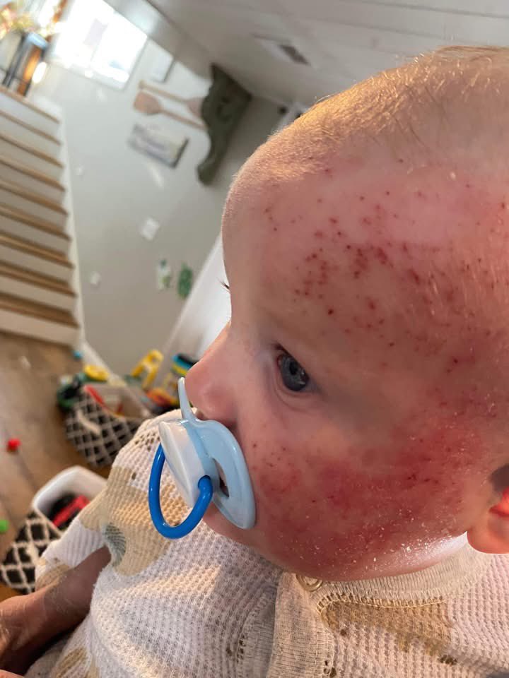 toobaffled's tweet photo. “I trusted my child’s doctors and listened to their suggestions. We followed all the rules. Did everything “right.” Took all advice. We got every vaccination. We ended up struggling with our first sons skin badly. Tried EVERY over the counter eczema treatment, creams, lotions, ointments. Tried all the steroids the doctors prescribed. Over and over. Higher and higher doses. Saw different specialists. With only very slight change to his skin. Our doctors suggested he would outgrow his skin issues and there was nothing to worry about, to just give it time…He went through complete steroid withdrawal. All the symptoms he previously had, he had worse, for several weeks. Finally recovering to his original state but not anywhere close to clear or comfortable. 

At this point we became pregnant with our second son and after his birth we began to try and manage two children with skin conditions. After our second boys 2 month check up it was clear his was worse than our first. We decided NO steroids this time. We could not watch a second child go through such a terrible thing. By his 4 month check up we knew something was very wrong. But after several extra trips to the office, no one in the office agreed. So we switched doctors.

By this time he’s having his 6 month appointment and got 7 vaccinations. Everything. Blew. Up. My precious baby was COVERED head to toe in rashes, pimples, scabbing. You name it, he had it. He couldn’t sleep more than 30-45 minutes at a time because of how uncomfortable he was. Ripping the skin and flesh from his body and only stopping once you pulled his hands off of himself. This is not exaggerated, that was our real life for over a year. We saw allergists, dermatologists, dietitians, multiple different doctors. As soon as we said we had a bad experience with steroids with our oldest and we wouldn’t be using them again, we were immediately wrote off. After several more months of driving him all over the state seeing different medical professionals, getting testing done, popping positive for more than a dozen different allergens, several different rounds of antibiotics, trying new diets; dairy free, grain free, sugar free, they only gave us two answers, a $4,000/month out of pocket injection or steroids. 

We felt so hopeless. Despite all our energy and resources being poured into our child’s healing, he was absolutely miserable. His primary care doctor’s response to this? Get him his next round of shots and hopefully he will grow out of it. Over a year of worsening symptoms and two offices she says sorry, hopefully he’ll be fine🤷🏻‍♀️😒 
If you didn’t guess already, he got extremely worse. I was so angry and heartbroken. We never returned to the second office after that day and I decided to switch gears on a whim. I booked with a naturopath. I cannot stress enough how this SAVED MY SONS LIFE. Immediately looking at him she knew he needed to detox from heavy metals. (Something he had been tested for in the world of western medicine and I was assured he was fine). Yet he had high levels of several different kinds. We started detox. After everything we had went through, I’ll admit I was skeptical. I had given up hope that it could be such an easy fix, but imagine that, he thrived. Almost instantly. He started being able to sleep, and without hand covers, then wear two piece outfits for the first time. He played in the dirt and swam in the lake, he grew drastically. Most importantly he was HAPPY!! For the first time in his short time here, he just got to be a kid. 

Now? He’s on a regular diet, eating all the foods he loves and growing by the second. None of the “allergens” are affecting him. We use NO over the counter creams/lotions. He sleeps ALL night long. Wrestles with his older brother. Most importantly, his skin is baby smooth for the first time in his life.❤️ detoxing healed our entire family, I could not be more thankful every day I trusted myself more than the doctors ..”

https://t.co/Nh3C0MfC2r?