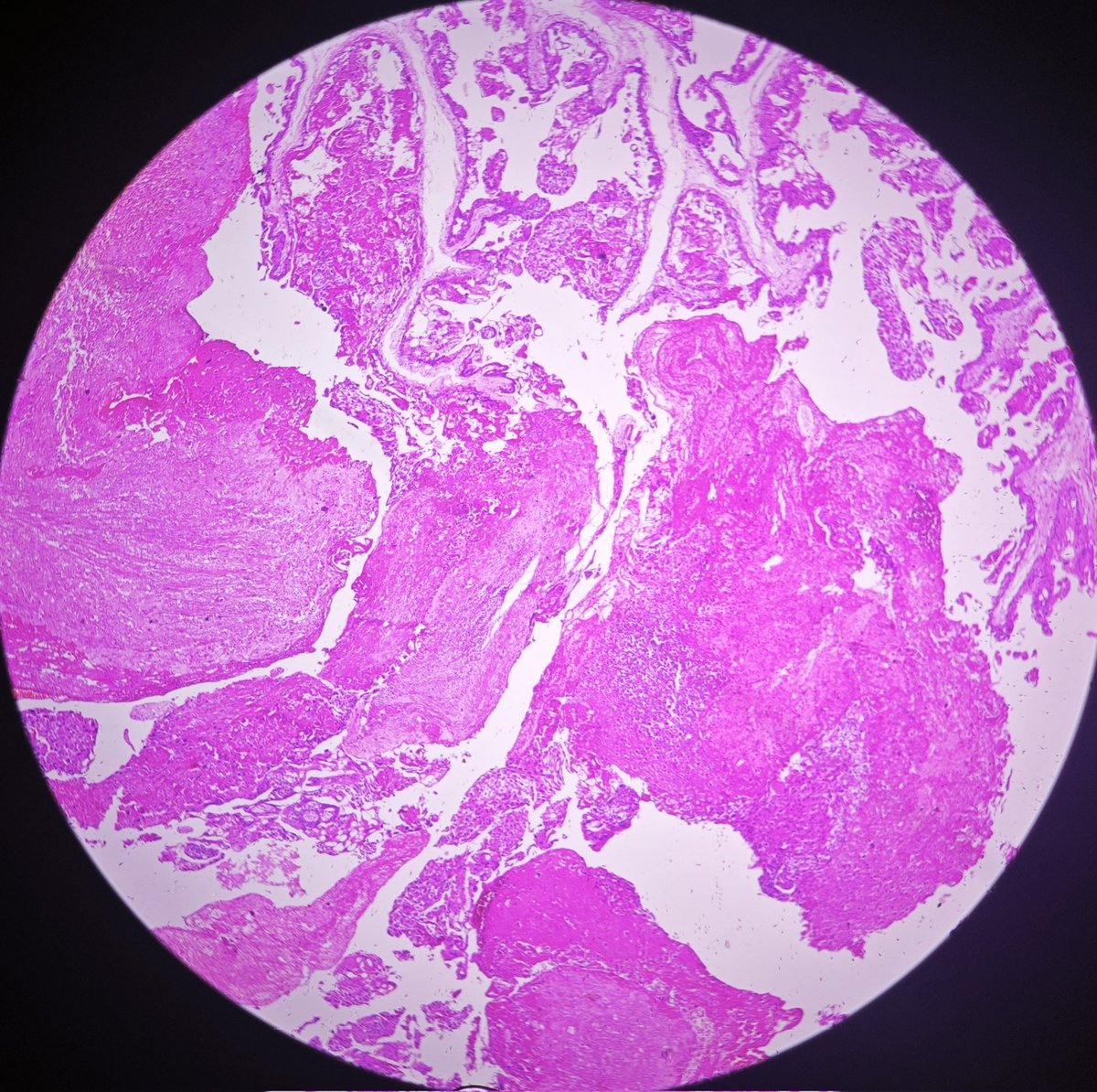 pathphyo's tweet photo. 41 yrs, old lady with hystrectomy done due to excesseive bleeding during suction currettage for H. Mole. Histology shows villous proliferation and invasion into myometrium consistent with imvasive hydatidoform mole.
#pathology #obstetricpath https://t.co/n4aKFoAabN