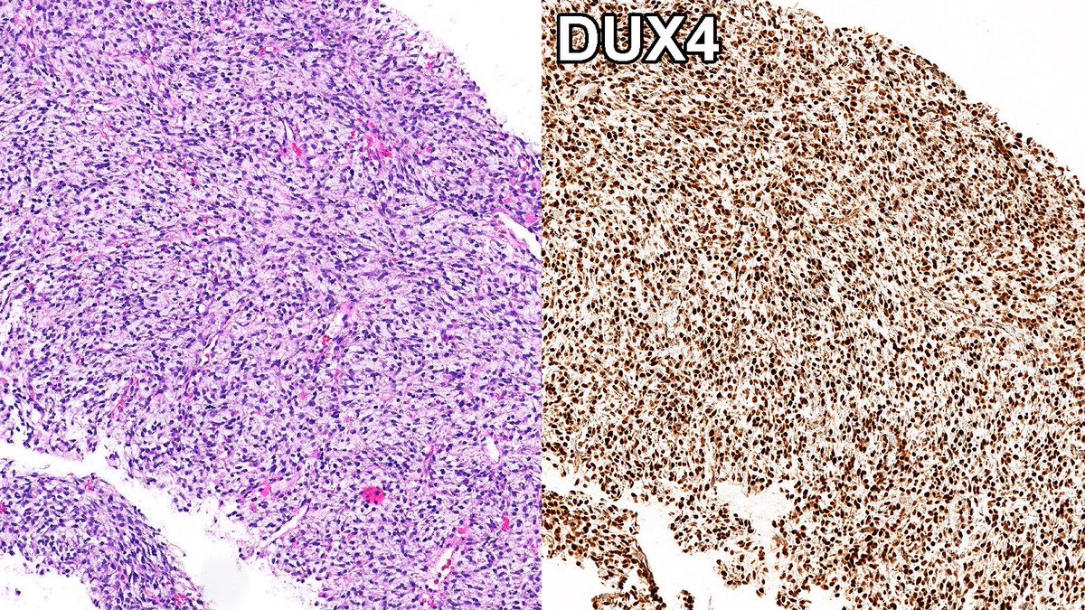 Case of CIC-Rearranged Sarcoma of Breast 🔬

DUX4 immunohistochemistry can be used to identify CIC::DUX4 fusion in CIC-rearranged sarcomas, distinguishing this lesion from other round cell sarcomas and malignant mimics in the breast.

#PathX #PathTwitter #breastpath