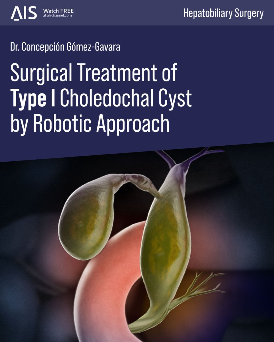 🤖 New Open Classroom! Dr. <a href="/GavaraGomez/">Concepción Gómez-Gavara</a> presents a step-by-step robotic approach for treating Type I Choledochal Cyst. Learn key techniques, including ICG-guided dissection and Roux-en-Y hepaticojejunostomy. 🔗 aischannel.com/on-demand/surg…  #IamAIS #some4surgery #RoboticSurgery