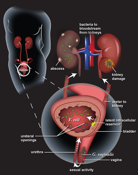 BorneWater's tweet photo. E. Coli infections can lead to serious illness, from stomach cramps to kidney failure. 🚨 Proper hygiene and food safety are key to prevention. Stay cautious and informed to protect yourself and others! #EColi #InfectionPrevention #HealthTips https://t.co/6SzqoqeX9u