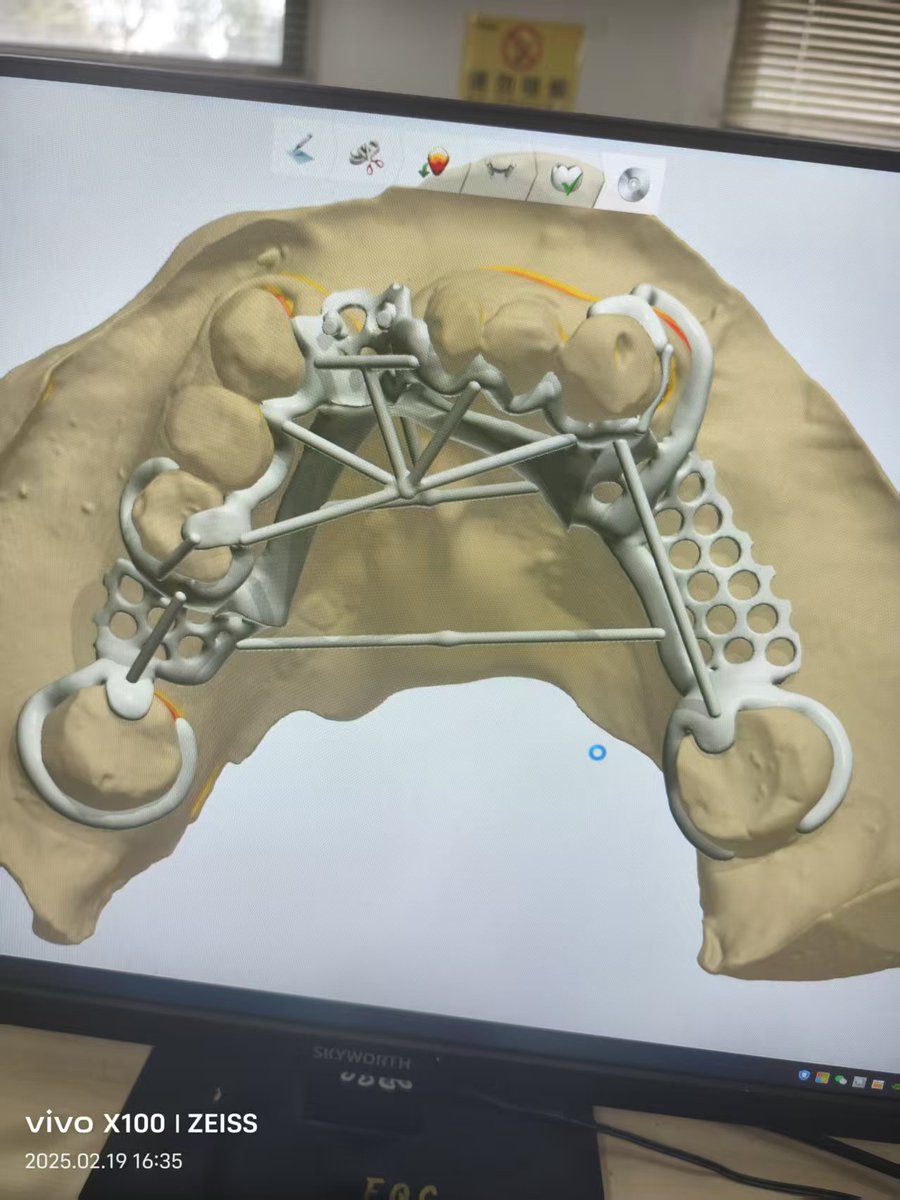 superdentsupply's tweet photo. This is a design for an European lab.Considering his origin,we designed a double lingual bar and a roach clasp. #digitaldental #partialframework #金属床 #ChromeCobaltpartial #dentallab https://t.co/IkHaelZOLN