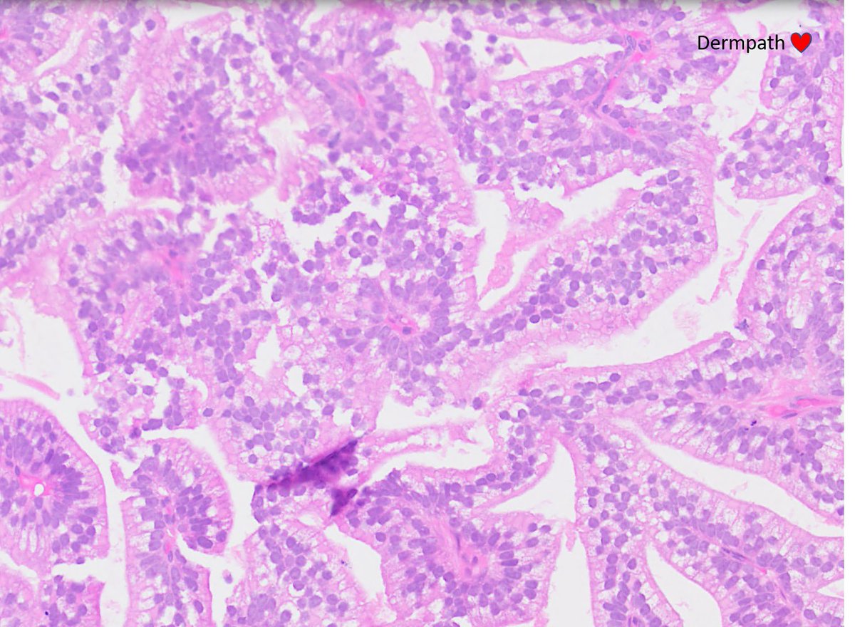Male, 70s, punch biopsy scalp ?keratinocyte cancer. What is it actually? #dermpath