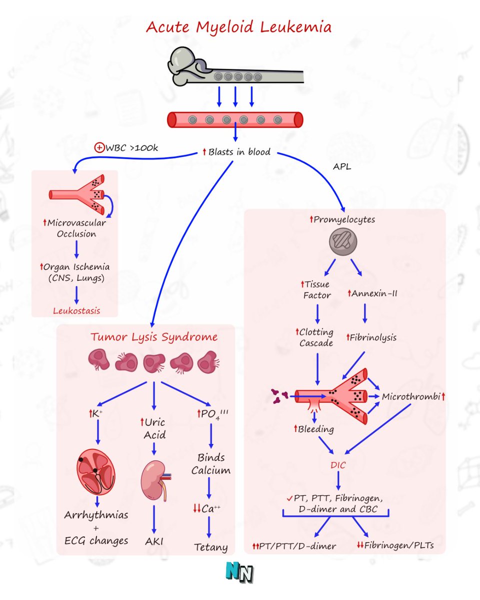 NinjaNerdSci's tweet photo. 🔬 ALL: Lymphoblasts flood the marrow → pancytopenia, CNS involvement, hepatosplenomegaly.
🔬 AML: Myeloblasts take over → bone marrow failure, risk of DIC, gum hypertrophy.
More study tools at https://t.co/ZeKt9Q18Es ✍️
 #AcuteLeukemia #Hematology #FutureMDs #StayNinjaNerdy https://t.co/23Qr4KuZdA