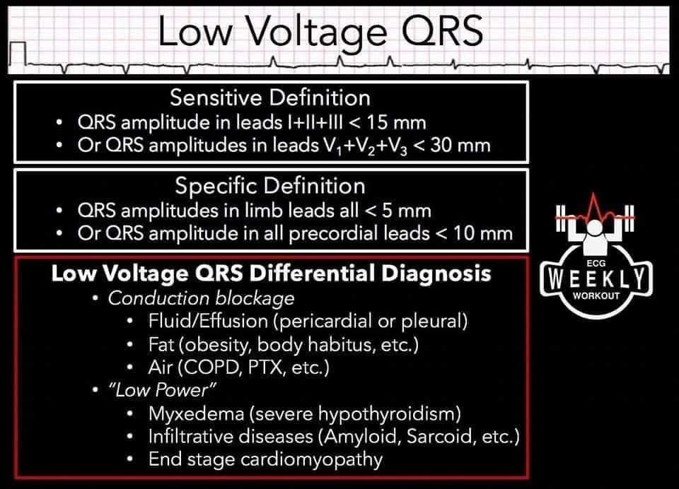 🔴 Low Voltage QRS on ECG: Diagnostic Criteria and DDx Two