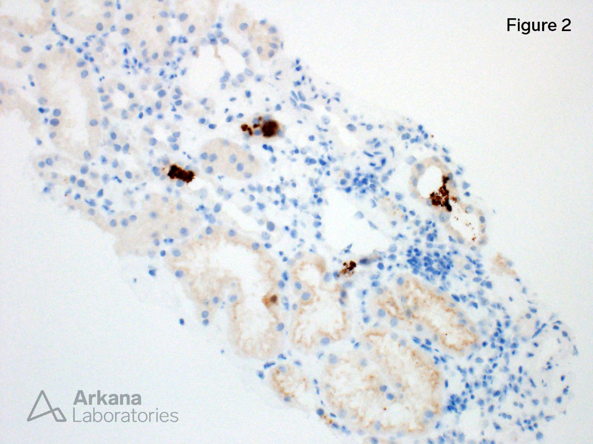 A 54-year-old man with a history of hypertension and hypercholesterolemia presented with complaints of generalized “muscle stiffness” and cola-colored urine. He was found to have markedly elevated serum creatinine and creatine kinase levels. A renal biopsy showed acute tubular