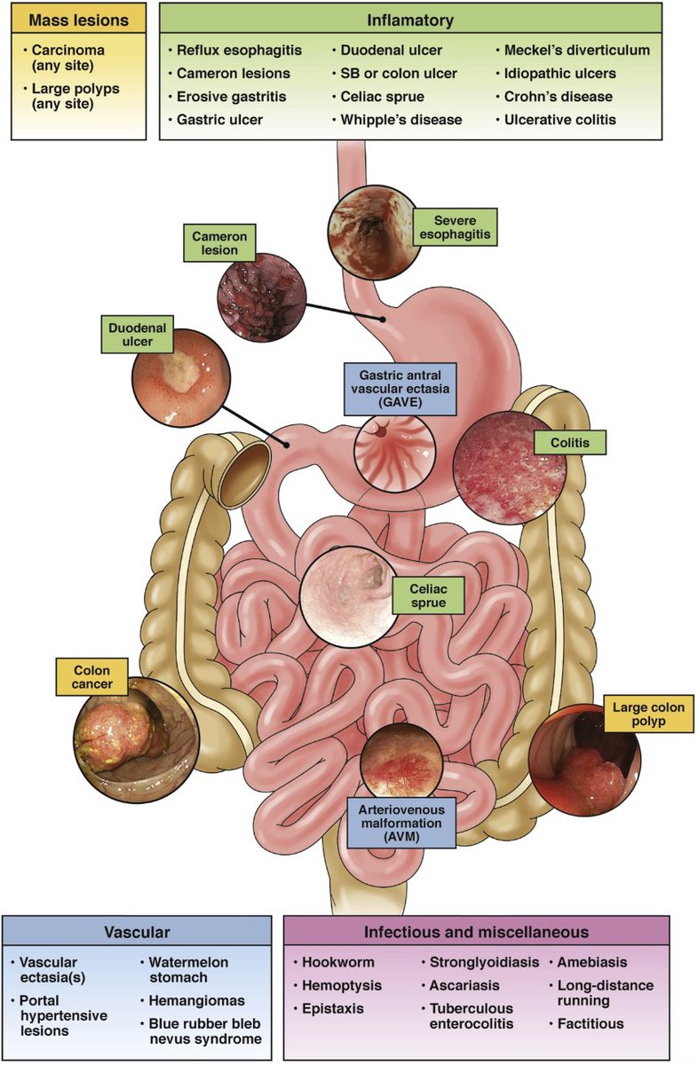 sepdigestiva's tweet image. Causas gastrointestinales de la anemia por deficiencia de hierro #4KMedEd @AGA_Gastro
👉gastrojournal.org/article/S0016-…