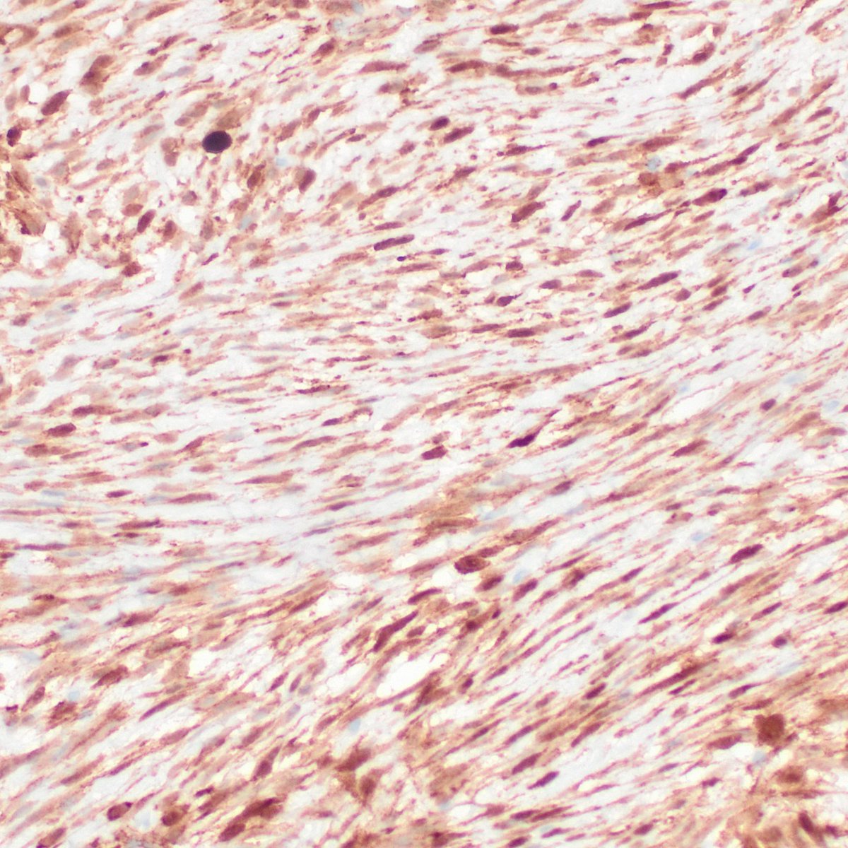 Intraoperative Consultation – Last Friday:
32-year-old woman with a retroperitoneal mass, suspected lymphoma based on CT findings. Touch imprint cytology, along with histological slide (similar to frozen section) and β-catenin IHC. #Pathology #Cytology #IntraoperativeConsultation