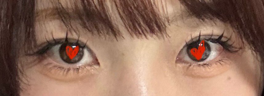 yuqi_once's tweet photo. 綺麗に末広の二重になった！
アザが出なかった方は5日くらいしたらほぼ落ち着いてたし、あざがでたほうも10日くらいしたら幅は落ち着いてたかな！理想通り🫶🏻 https://t.co/nZbtoTZ6ti