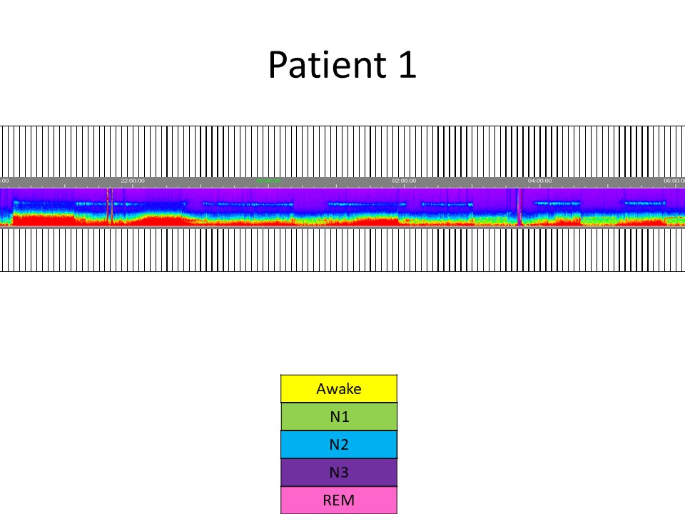 Journal of Clinical Neurophysiology (@jclinneurophys) on Twitter photo Rudock et al show that #EEG density spectral array can be used to identify sleep stages without relying on traditional polysomnography for #pediatric patients with normal PSG. 💤⚡🛏️ <a href="/WashUNeurology/">WashU Medicine Neurology</a> <a href="/ACNS_org/">ACNS</a> Read here: bit.ly/3Dj63MF Rudock et al show that #EEG density spectral array can be used to identify sleep stages without relying on traditional polysomnography for #pediatric patients with normal PSG. 💤⚡🛏️ <a href="/WashUNeurology/">WashU Medicine Neurology</a> <a href="/ACNS_org/">ACNS</a> Read here: bit.ly/3Dj63MF