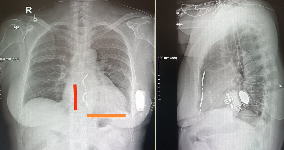 RESPUESTA

Sobresensado de la onda P! 
Esta paciente tiene un auriculón derecho (👀 al TAC) y con el vector se detección Ring1-Ring2 (línea 🔴) ve tanto la P como la R... mala cosa por el doble contaje para un DAI

Lo solucionamos reprogramando al vector Ring2-Carcasa (línea 🍊)