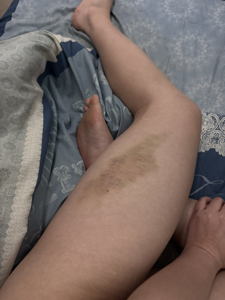 人家今天只是捐血而已
為什麼會這樣🥺🥺 https://t.co/jb9PGcS20c