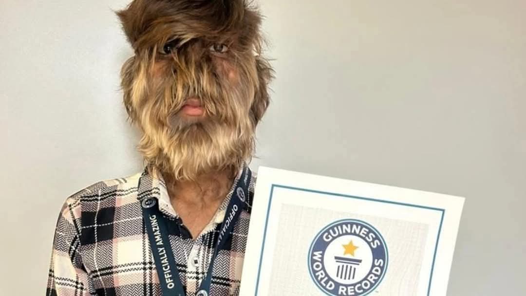 रतलाम के ललित पाटीदार का नाम गिनीज बुक ऑफ वर्ल्ड में दर्ज किया गया है। ललित को वेयरवोल्फ सिंड्रोम नामक दुर्लभ बीमारी है, जिसके कारण उनके चेहरे पर घने बाल हैं। गिनीज बुक ऑफ वर्ल्ड रिकॉर्ड की टीम ने ललित को सर्टिफिकेट और मैडल दिया है।