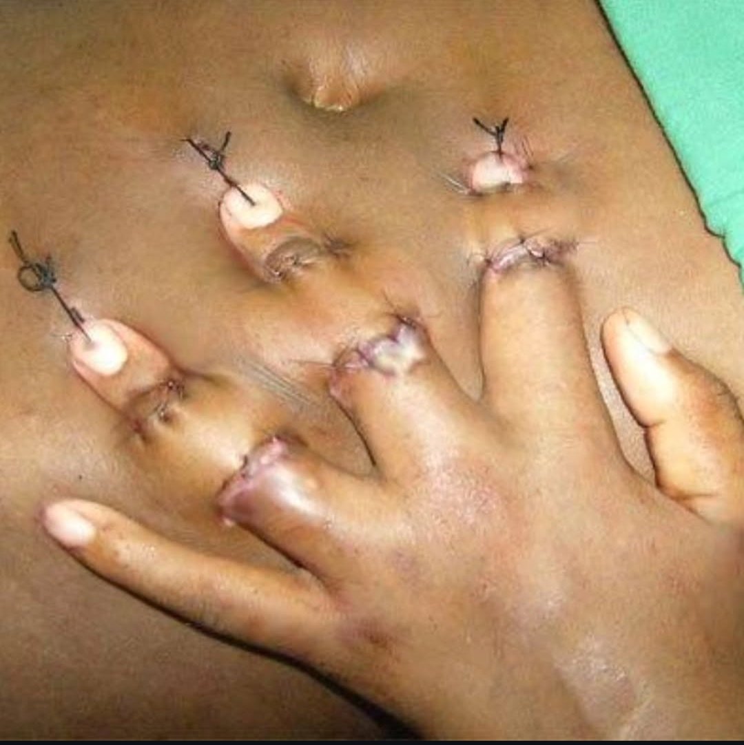 lucentshyam99's tweet photo. Medical innovation at work!
This procedure, known as "pocket surgery," helps save severely damaged fingers by temporarily implanting them in the abdomen to promote healing.A life-saving alternative to amputation.
#PocketSurgery #MedicalMiracle #SurgicalInnovation #Healing #Medx https://t.co/q84Th4bnme