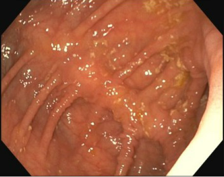 Erik Holzwanger, MD, ABOM-D (@hilarholzy) on Twitter photo ❓You're doing an upper endoscopy and you see the anatomy below. What happened here?#GITwitter #MedTwitter #MedEd #surgery <a href="/AmerGastroAssn/">American Gastroenterological Association (AGA)</a> <a href="/ASGEendoscopy/">ASGE GI Endoscopy</a> <a href="/AmCollegeGastro/">ACG</a> <a href="/MoamenGabrMD/">Moamen Gabr</a> <a href="/Taalamri/">Turki AlAmri |تُرْكي عبدالله الْعَمريَّ MD</a> <a href="/AhmadBazarbashi/">Ahmad N. Bazarbashi أحمد بازارباشي</a> <a href="/DrSaeeeed/">Ahmed Saeed, MD, DABOM</a> <a href="/EndoscopyOthman/">Mohamed Othman</a> <a href="/SahajRathi/">Sahaj Rathi MD, DM, MRCP</a> <a href="/drkeithsiau/">Keith Siau</a> <a href="/stevenbollipo/">Steven Bollipo</a> ❓You're doing an upper endoscopy and you see the anatomy below. What happened here?#GITwitter #MedTwitter #MedEd #surgery <a href="/AmerGastroAssn/">American Gastroenterological Association (AGA)</a> <a href="/ASGEendoscopy/">ASGE GI Endoscopy</a> <a href="/AmCollegeGastro/">ACG</a> <a href="/MoamenGabrMD/">Moamen Gabr</a> <a href="/Taalamri/">Turki AlAmri |تُرْكي عبدالله الْعَمريَّ MD</a> <a href="/AhmadBazarbashi/">Ahmad N. Bazarbashi أحمد بازارباشي</a> <a href="/DrSaeeeed/">Ahmed Saeed, MD, DABOM</a> <a href="/EndoscopyOthman/">Mohamed Othman</a> <a href="/SahajRathi/">Sahaj Rathi MD, DM, MRCP</a> <a href="/drkeithsiau/">Keith Siau</a> <a href="/stevenbollipo/">Steven Bollipo</a>