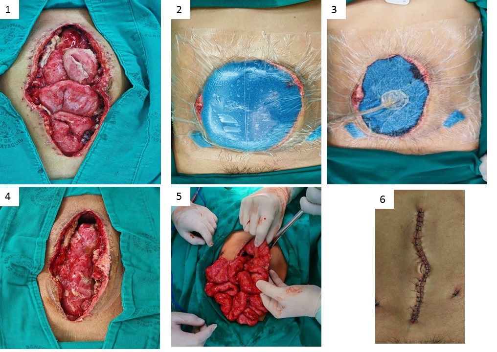 jorgepuntofijo's tweet photo. 🔬 ABTHERA in Pediatric Hostile Abdomen 🔬

📖 Full link (English &amp; Spanish): [https://t.co/YAghDTM0hZ]

📸 Includes patient images (with consent).

❗ No conflicts of interest.

💬 Have you used NPT in pediatrics? Share your thoughts!

#PediatricSurgery #ABTHERA https://t.co/pNDcAR1brn