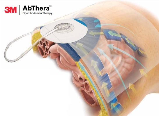 jorgepuntofijo's tweet photo. 🔬 ABTHERA in Pediatric Hostile Abdomen 🔬

📖 Full link (English &amp; Spanish): [https://t.co/YAghDTM0hZ]

📸 Includes patient images (with consent).

❗ No conflicts of interest.

💬 Have you used NPT in pediatrics? Share your thoughts!

#PediatricSurgery #ABTHERA https://t.co/pNDcAR1brn
