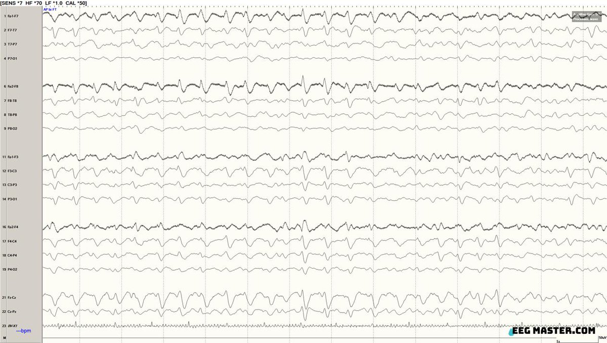 The following EEG is from a patient in the ICU. Based on the ACNS standardized critical care EEG terminology from 2021, what best describes the EEG finding. Click on this link to view the options, submit your answer and see the explanation. eegmaster.com/eegmaster/quiz….